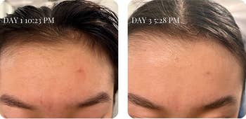 a before and after using the face wash, showing how it cleared up a breakout