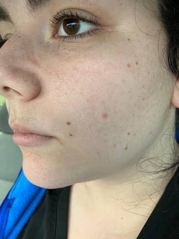 reviewer's after photo showing almost completely clear skin