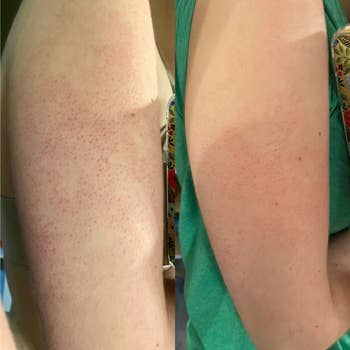 reviewer before and after of their arm with red bumps and then their arm with smoother, less irritated skin, from using the scrub