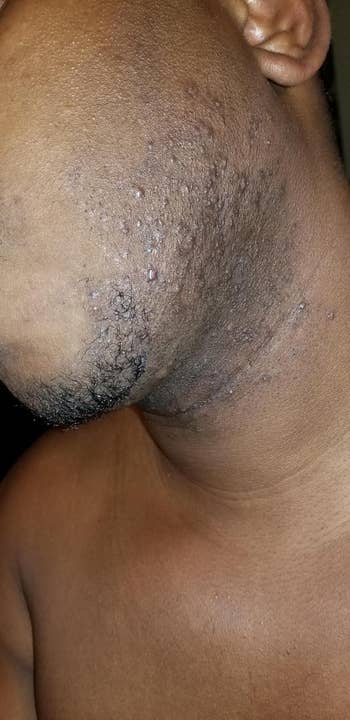 Reviewer with razor bumps and ingrown hairs connected  their cervix  and jawline