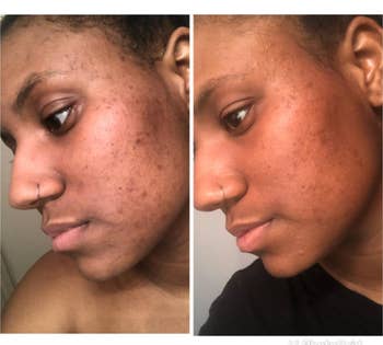reviewer showing before and after using liquid exfoliant