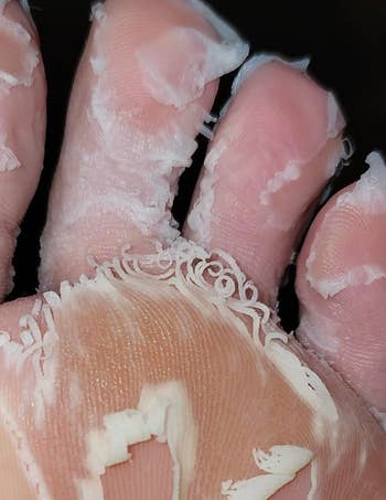 Close-up of peeling tegument connected a foot, perchance aft utilizing a ft disguise oregon treatment