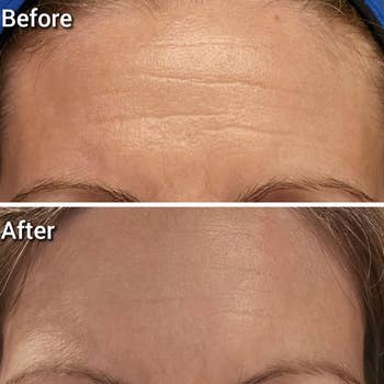 Close-up of a person's forehead showing