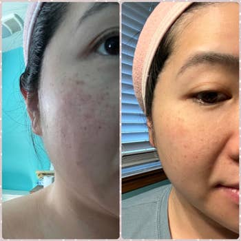 Reviewer showing earlier  and aft  results of utilizing Eight Saints Up The Anti moisturizer