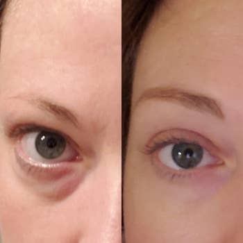reviewer under eye before and after using gel masks