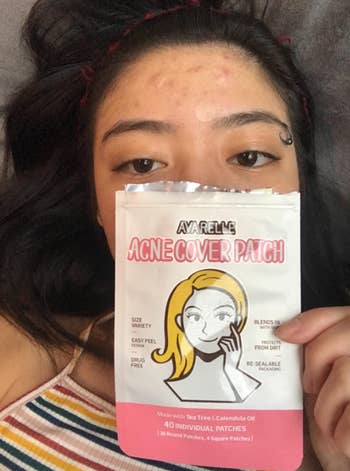 Close up of reviewer's face holding the pimple patch packaging and using a few of the patches on their forehead