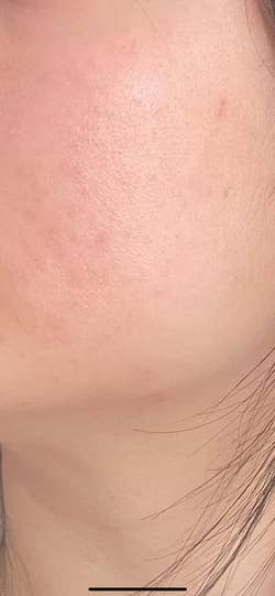 reviewer with improved skin and little to no acne spots after using essence
