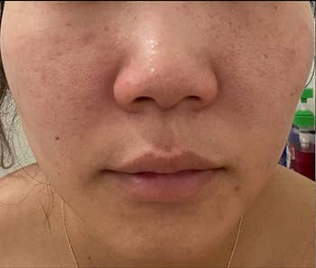 Reviewer before image with redness in skin 