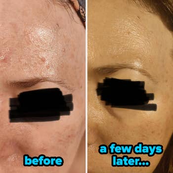 near broadside with acne and blemishes labeled