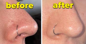 before and after of a reviewer's nose with blackheads and then clear
