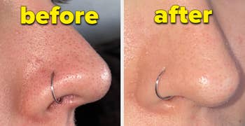 before and after of a reviewer's nose with blackheads and then clear