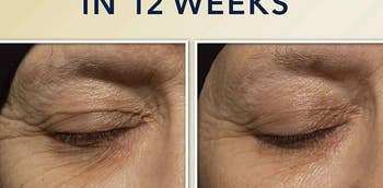 models wrinkles before and after using retinol cream, wrinkles appear tighter after