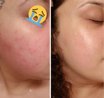 side by side before and after showing the wash got rid of a reviewer's red, irritated cheek acne