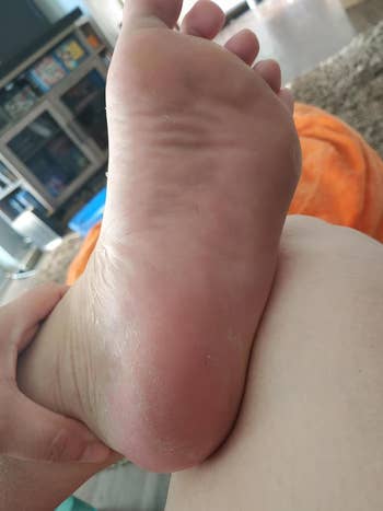 Close-up of same person's heel showing smooth, soft skin after peeling has finished