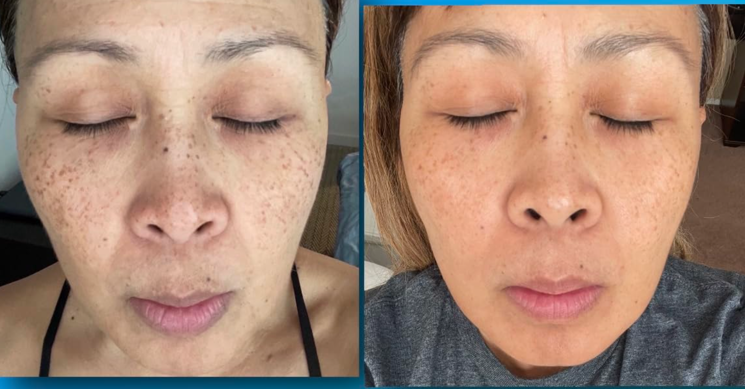 reviewer earlier  and aft  vitamin c serum 