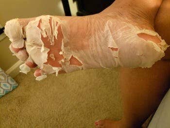 reviewer's entire bottom of their foot peeling