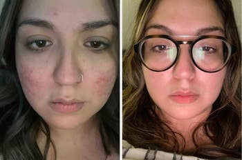 Before and after comparison of a person's facial skin with improved clarity, possibly for a skincare product review or promotion