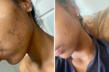 Reviewer before and after with acne scars lightened by the bar 