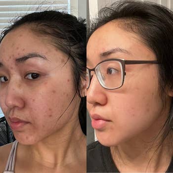 reviewer before of their skin with dark spots and after with spots significantly faded
