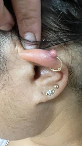 reviewer's ear with a keloid bump on their piercing