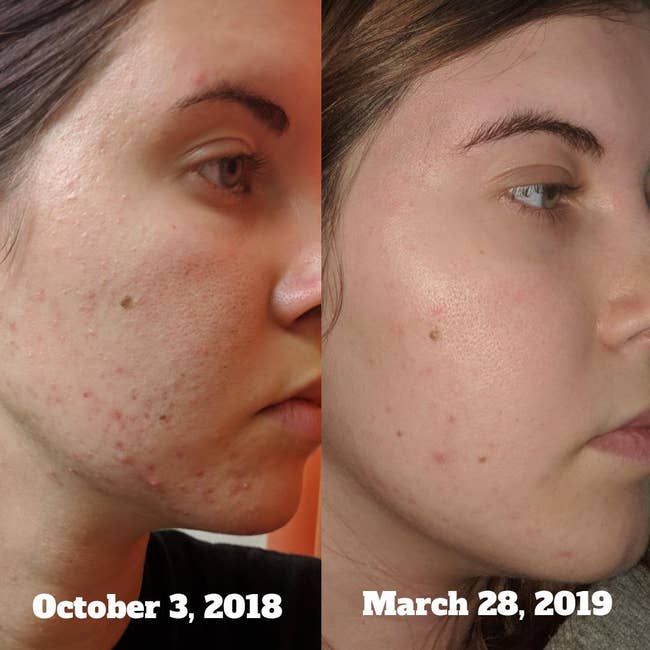 Reviewer's before-and-after of broken-out cheek and then clear cheek less than six months apart