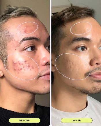 A reviewer with acne in the 