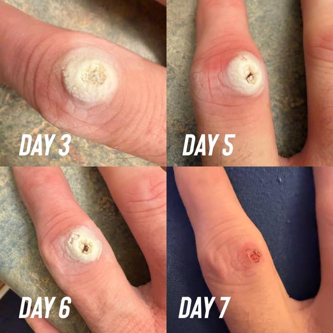 Four close-up images show a finger wart's progression over days 3, 5, 6, and 7, highlighting treatment changes