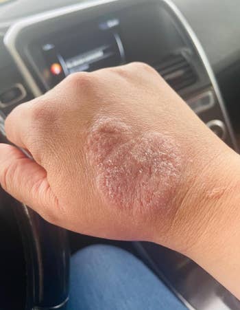 reviewers hand with eczema breakout