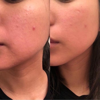 reviewer before and after of their skin less bumpy after using the tool