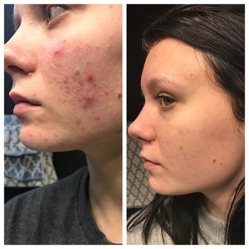 A reviewer's before and after photo which shows her skin much clearer and brighter