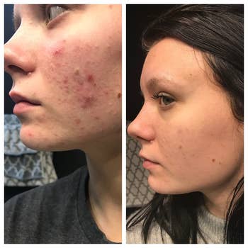 A reviewer's before and after photo which shows their skin much clearer and brighter