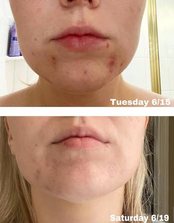 reviewer before with acne on their chin and after with it significantly less red and inflamed just 4 days later