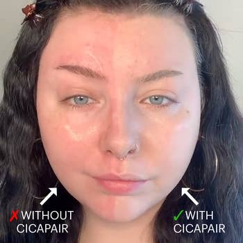 model's face, half of which is bare with redness, while the other half looks much more even with the color correcting treatment applied