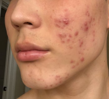 before photo of a reviewer's dark red and inflamed cheek and jawline acne