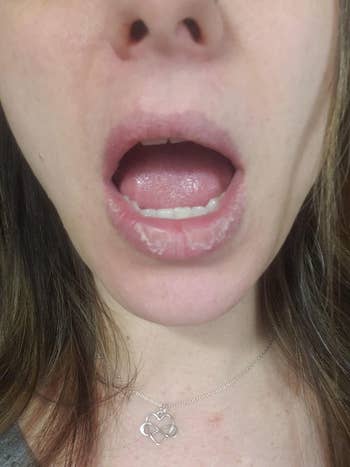 before representation  of reviewer's precise  chapped lips