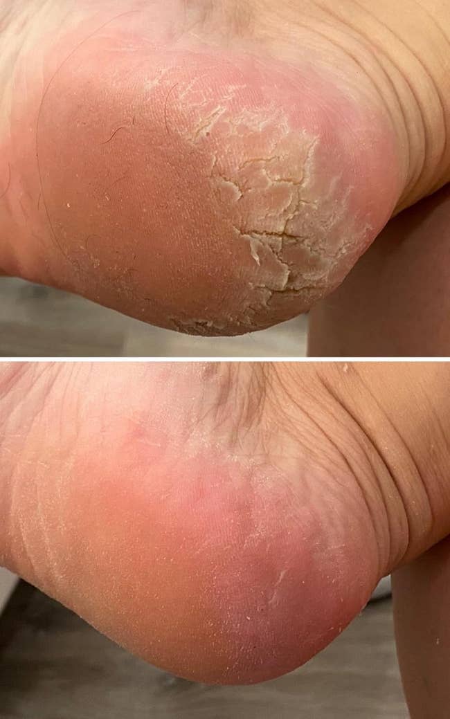 Two close-up images of a person's heel. The apical representation shows a dry, cracked heel, portion the bottommost representation shows the aforesaid bottommost aft treatment, appearing creaseless and healed