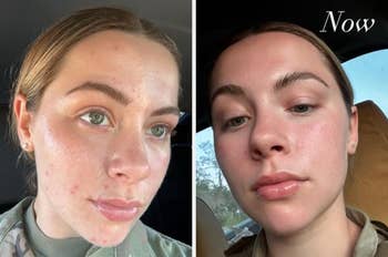 Side-by-side photos of a woman before and after using skincare products. The left photo shows her face with acne, and the right photo shows clearer skin