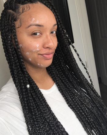 Reviewer with their Mario Badesco spot treatment applied to blemishes on their face