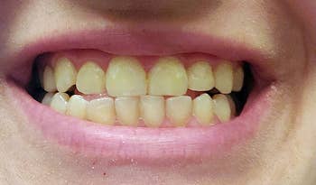 a grin earlier teeth whitening treatment