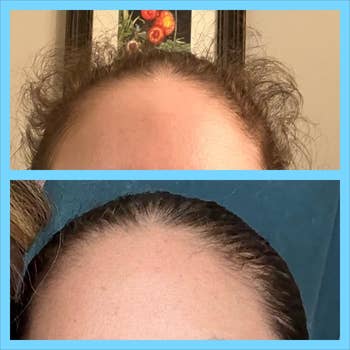 Before and after images showing the results of a hair-smoothing treatment on a person's forehead