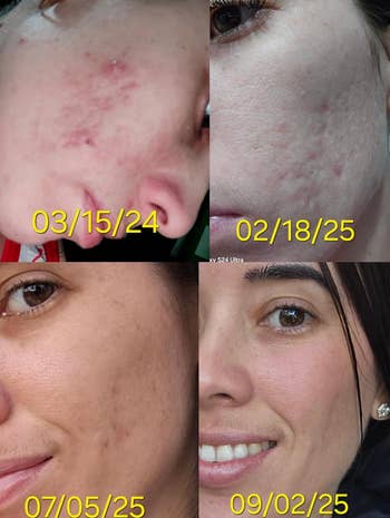 Four close-up photos showing skin improvement over time from March 2024 to September 2025. Dates: 03/15/24, 02/18/25, 07/05/25, 09/02/25