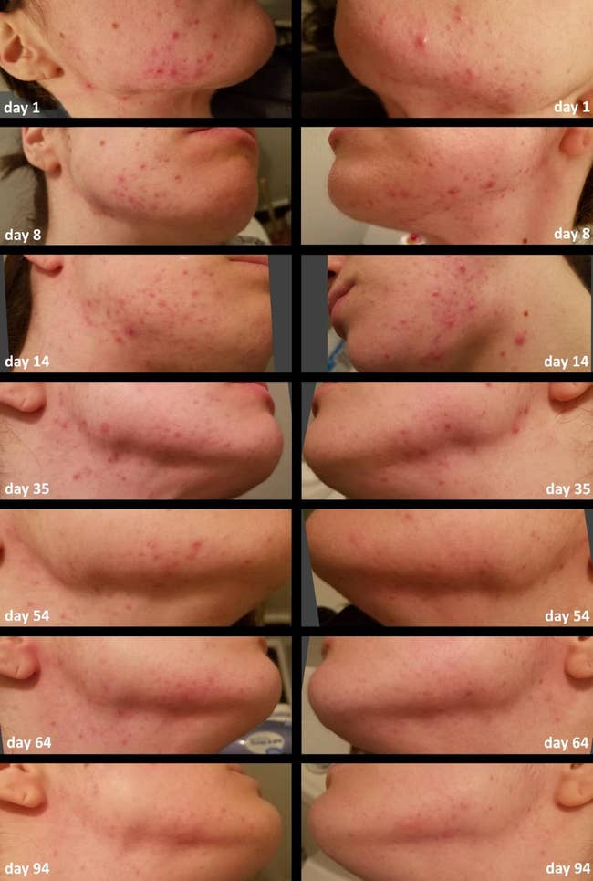 A person's acne attraction advancement is shown implicit 94 days. The images show the betterment successful tegument information with reduced acne connected the jawline and chin area