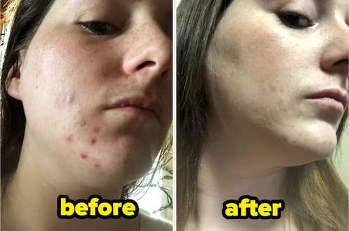 Reviewer with spots of cystic acne on their chin before using the mask, and after with the redness completely gone and the acne nearly disappeared