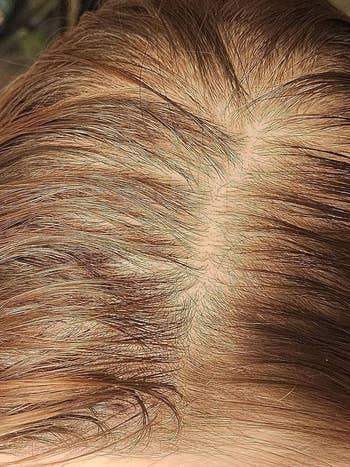 Close-up view of a person's scalp showing it looks oily
