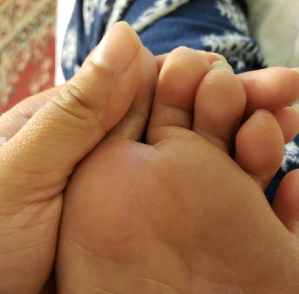 the same reviewer's foot with no warts or scars after using product 