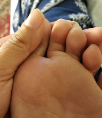 the same foot with no warts or scars after using product 