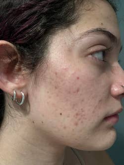 Profile of a person showing skin texture and acne 