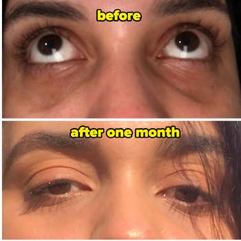 Before, reviewer with dark under-eyes, and after one month of using the product, reviewer with no visible under-eye circles and eyes looking clear and bright