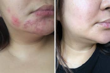 Reviewer with acne scars and an after image of the scars faded 