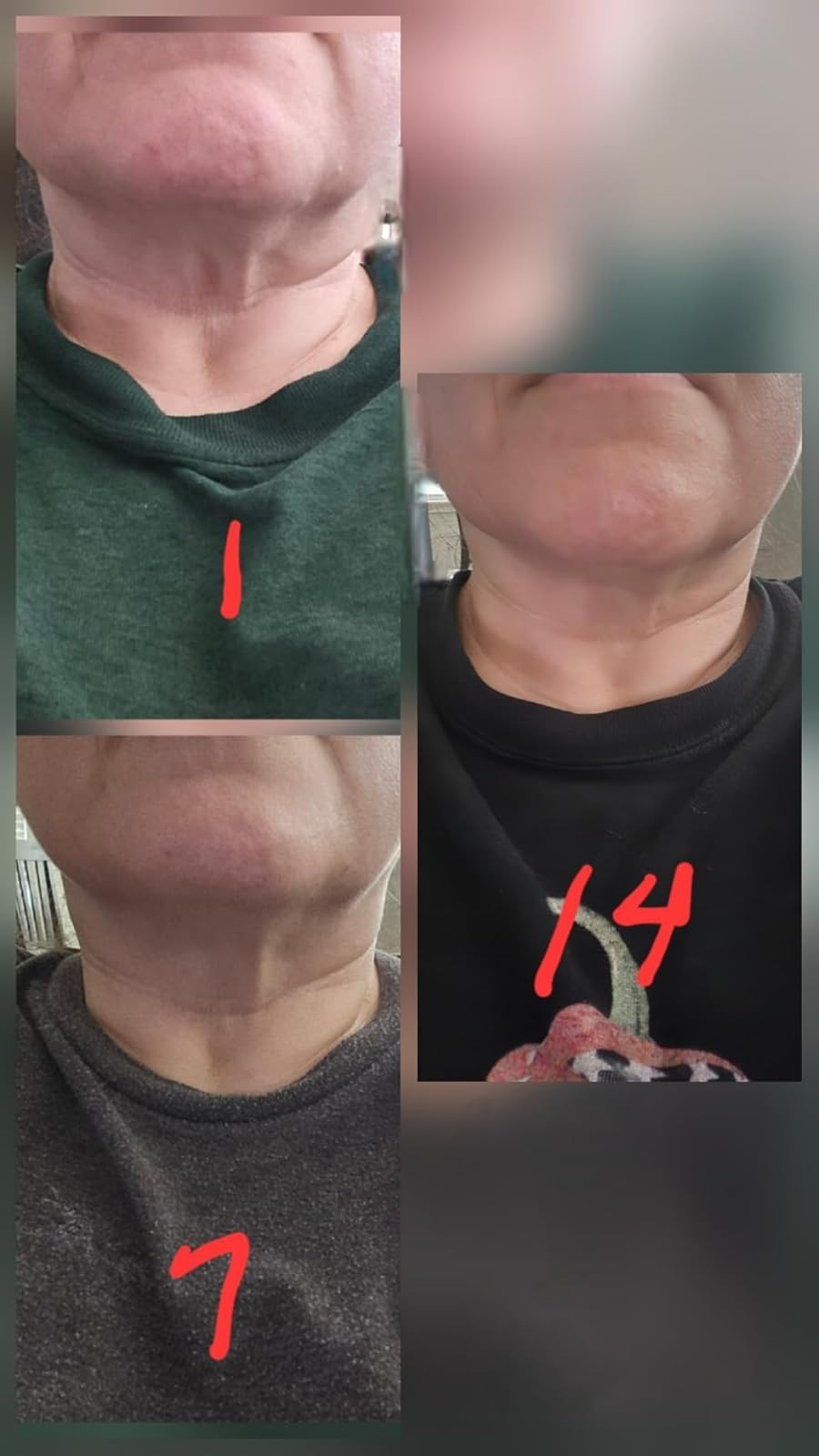 Collage showing progression of a person's cervix  astatine  antithetic  stages, labeled 1, 7, and 14, indicating a two-week timeline